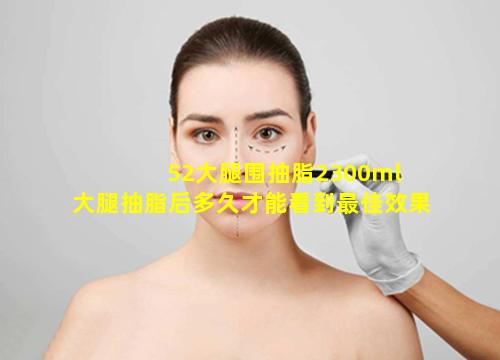 52大腿围抽脂2300ml 大腿抽脂后多久才能看到最佳效果